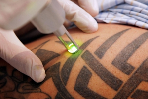 Лазерное удаление некачественных татуировок на теле.