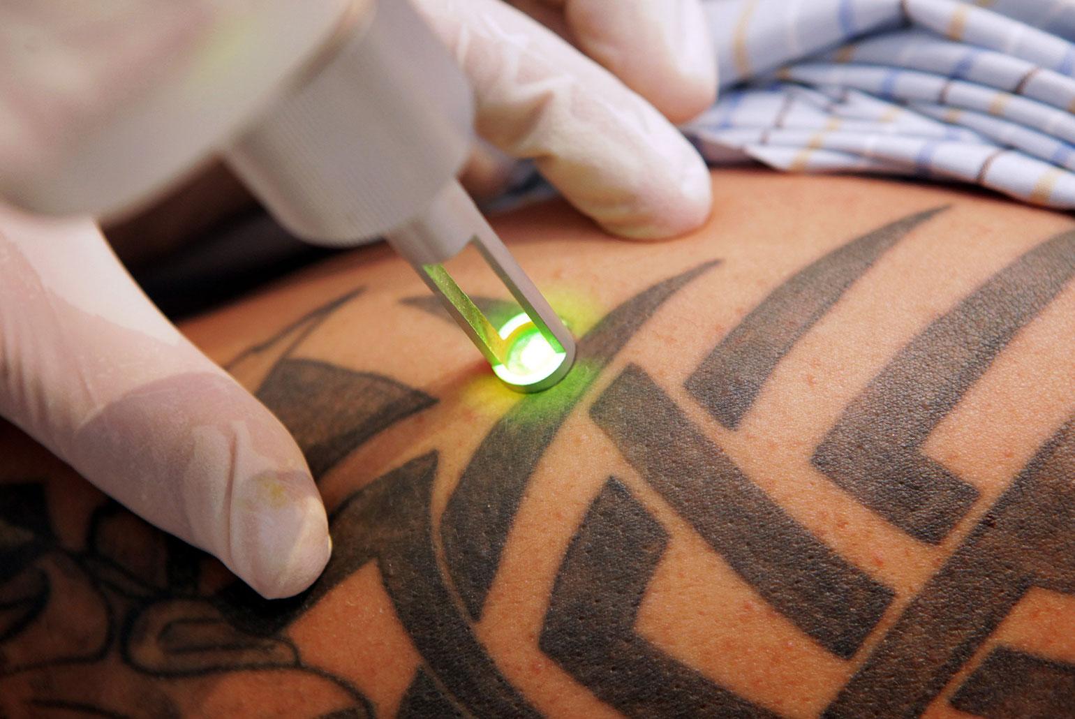 Лазерное удаление татуироврк, перманента